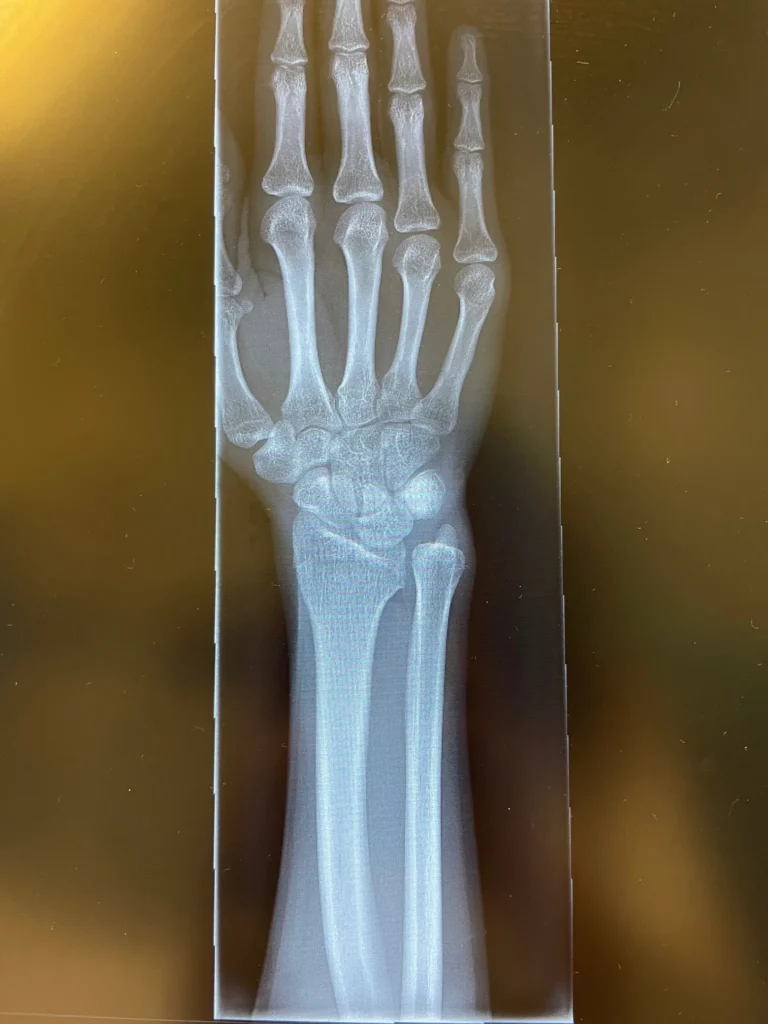 Röntgenbild des Handgelenks mit Platte nach Ellenverkürzung
